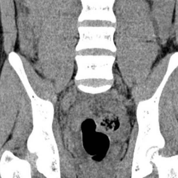 cau-be-14-tuoi-bi-liet-hai-chan-do-dut-tuy-song-sau-tai-nan-giao-thong