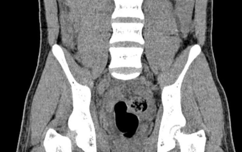 cau-be-14-tuoi-bi-liet-hai-chan-do-dut-tuy-song-sau-tai-nan-giao-thong