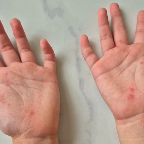 ca-tay-chan-mieng-tang-manh,-chung-virus-gay-benh-nang-‘tai-xuat’