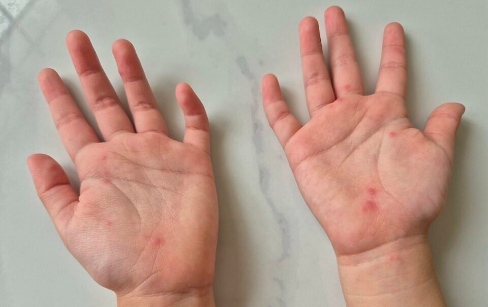 ca-tay-chan-mieng-tang-manh,-chung-virus-gay-benh-nang-‘tai-xuat’