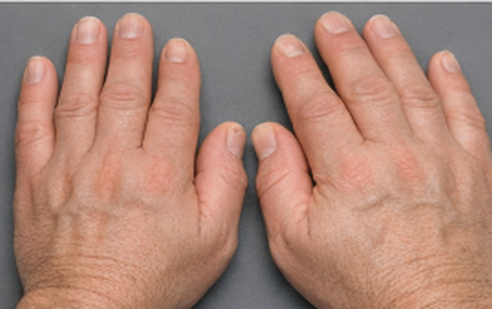 bong-dung-ban-tay,-ban-chan-to-ra:-co-the-la-dau-hieu-benh-ly-nguy-hiem