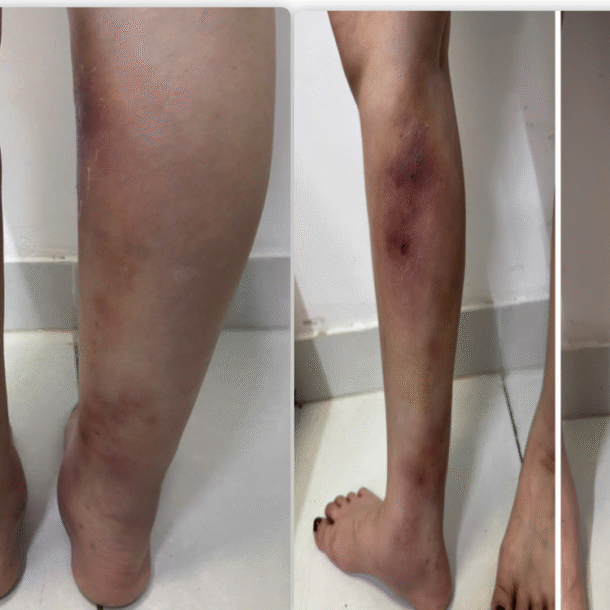 chan-bien-dang-sau-tiem-filler-lam-thang-chan-tai-nha