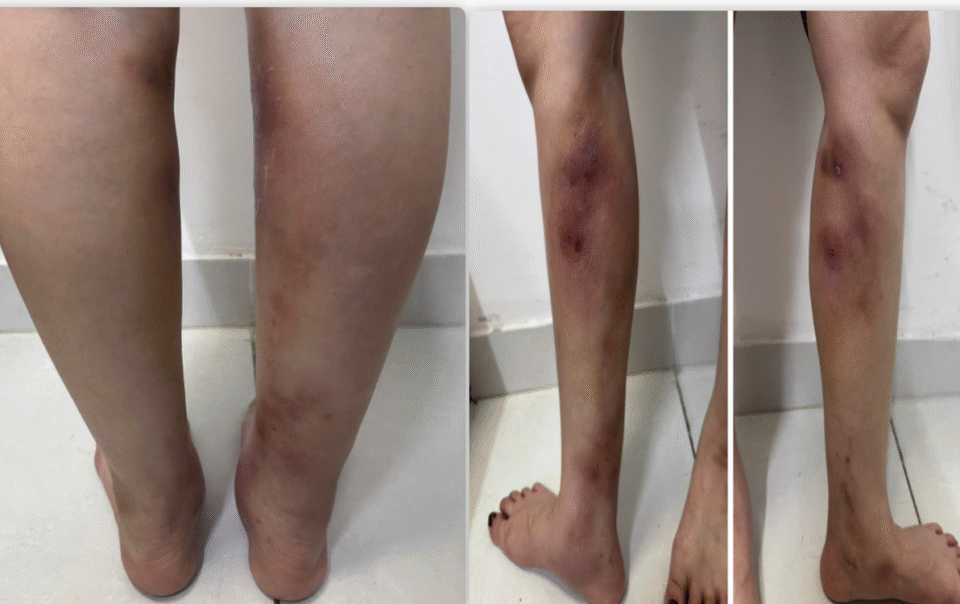 chan-bien-dang-sau-tiem-filler-lam-thang-chan-tai-nha