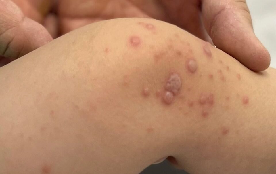 tphcm:-benh-tay-chan-mieng-tang-manh,-hon-8.150-ca-mac,-4-ca-tu-vong