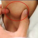 Viêm tuyến giáp có làm tăng nguy cơ ung thư?